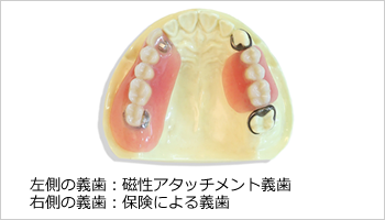 左側の義歯：磁性アタッチメント義歯右側の義歯：保険による義歯