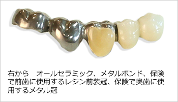 右から　オールセラミック、メタルボンド、保険で前歯に使用するレジン前装冠、保険で奥歯に使用するメタル冠